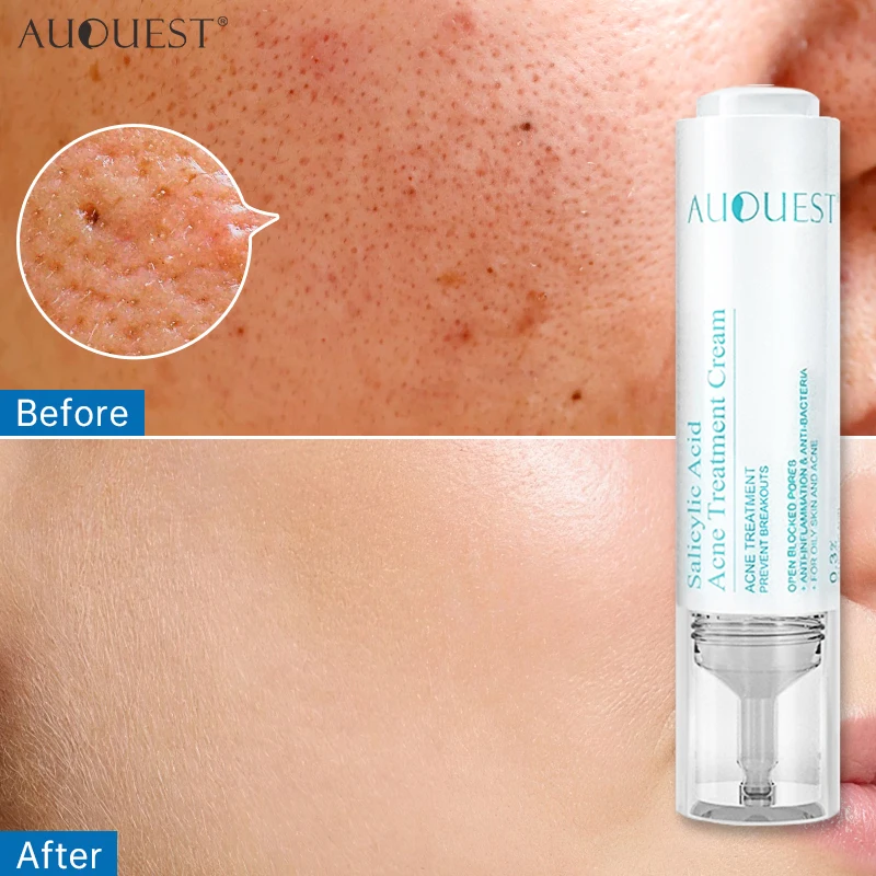 Crème anti-acné salicVAC, élimine impuretés et hydrate. – Test et Avis