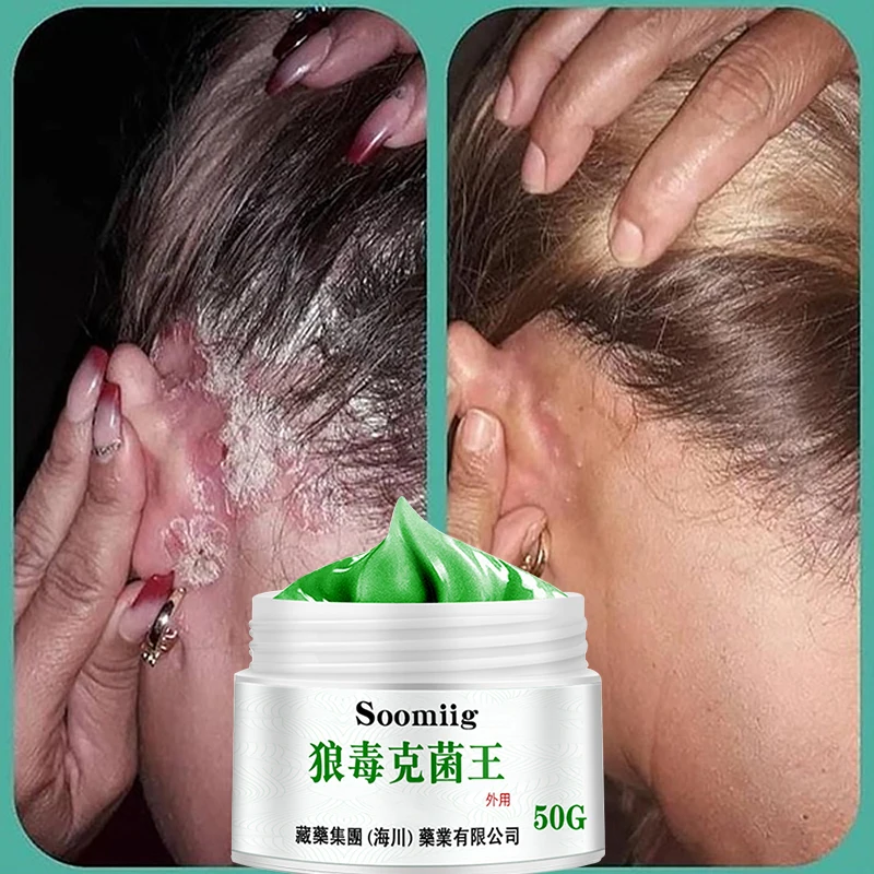 Crème anti-psoriasis aux extraits de plantes. – Test et Avis