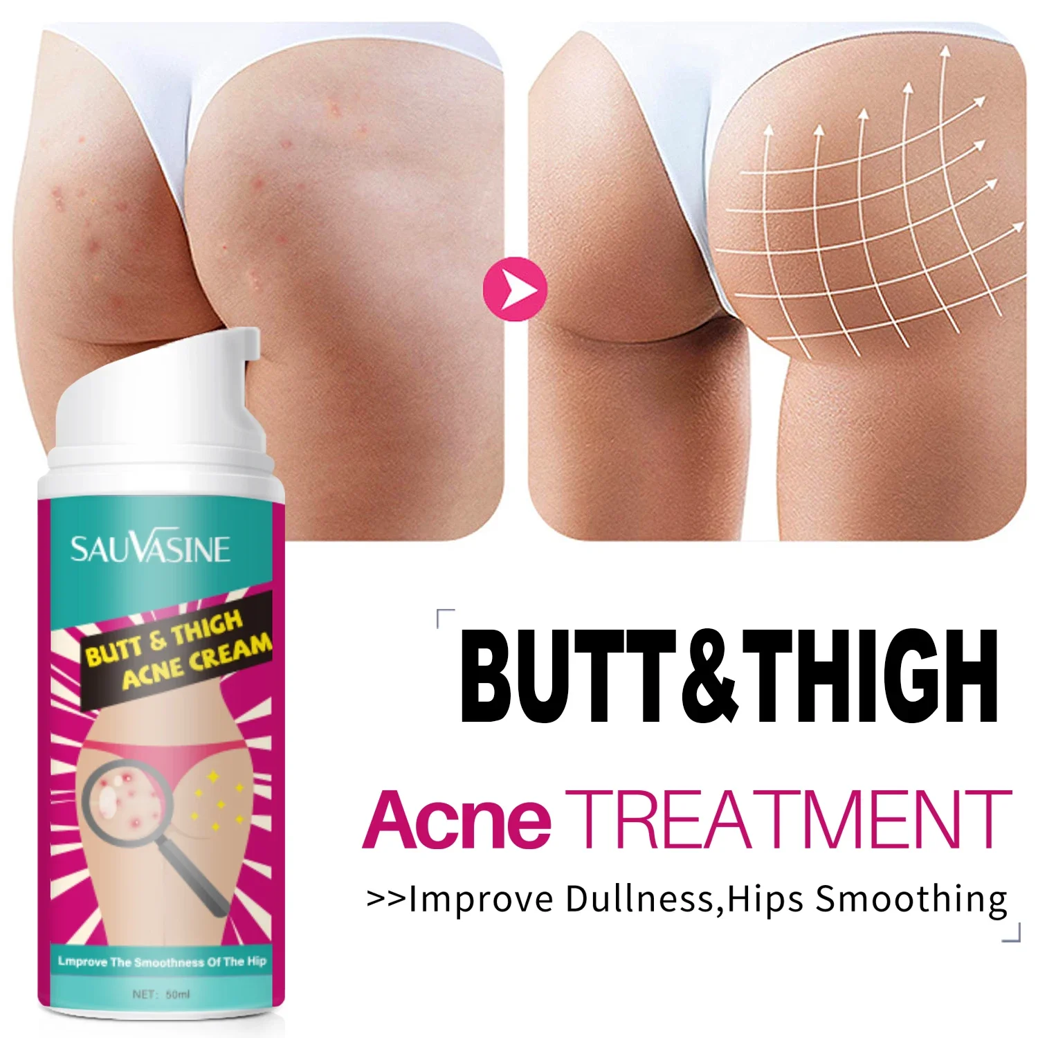 Crème de traitement pour l’acné des fesses – Test et Avis
