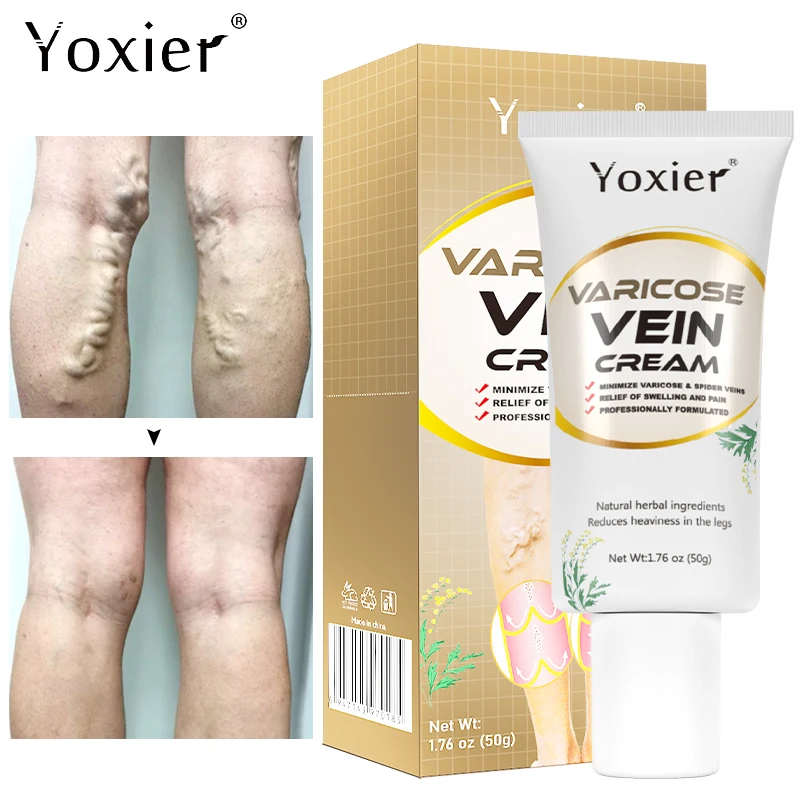 « Crème réparatrice pour varices et phlébite » – Test et Avis