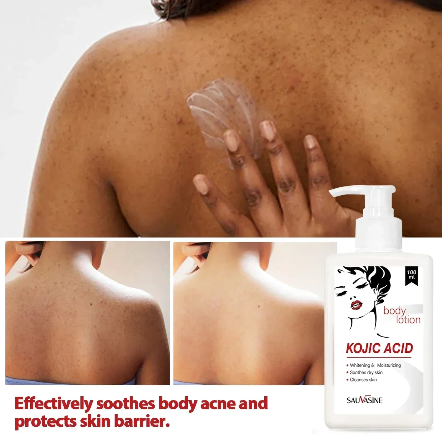 Kojic-Crème: éclaircit, élimine acné et taches – Test et Avis