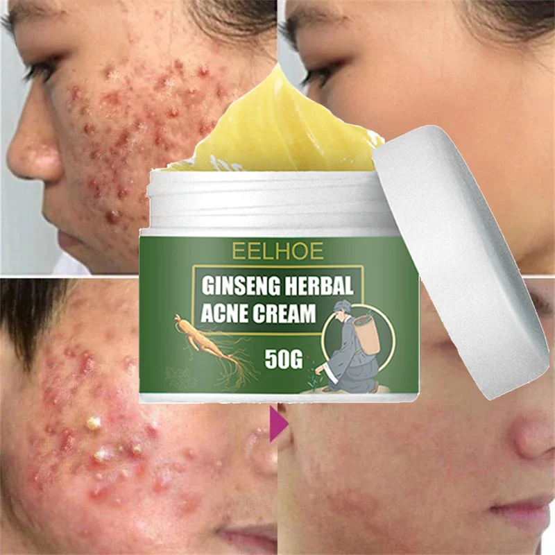 « Traitement acné ginseng herbes: boutons, cicatrices, pores » – Test et Avis