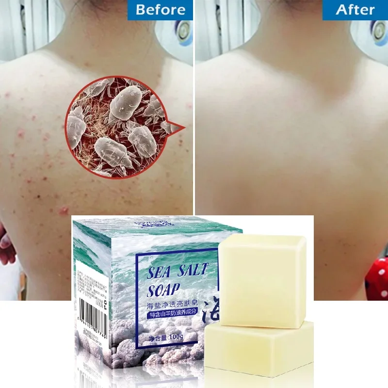 « Traitement complet contre l’acné avec lait de chèvre » – Test et Avis