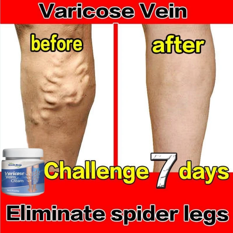 Traitement naturel contre les problèmes veineux – Test et Avis
